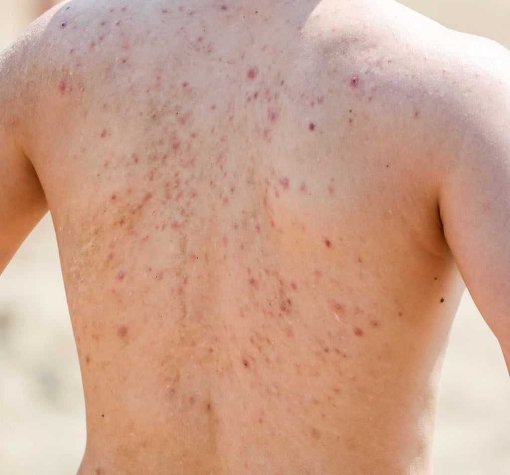 Acne on your back